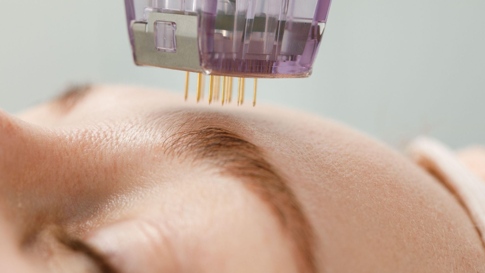 Wie wirkt Microneedling und für wen ist es geeignet?