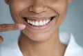 Gingivales Lächeln