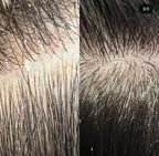 Anti-Schuppen-Shampoo Pflege für trockene, fettige Schuppen und schuppige Haut.