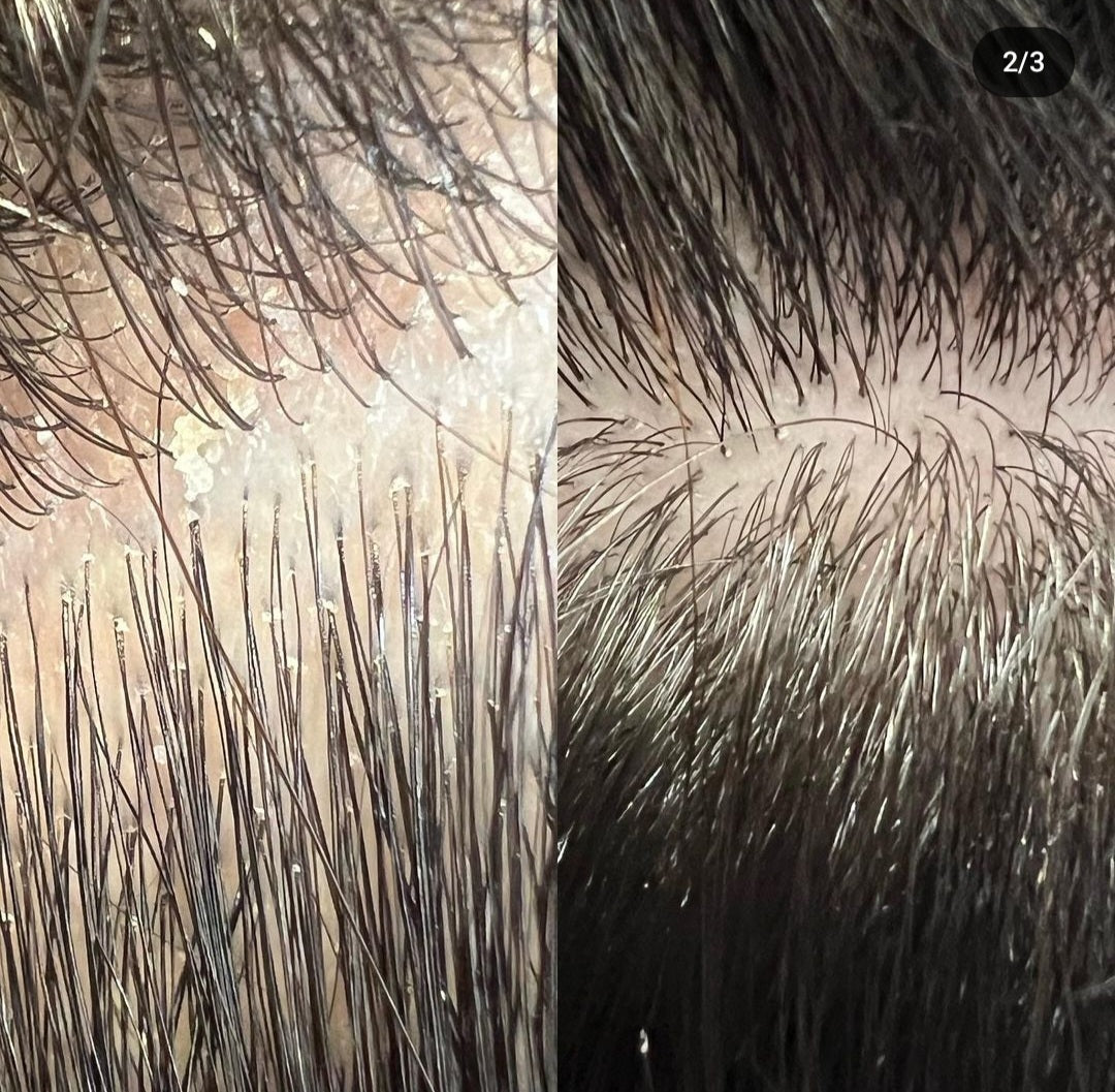 Anti-Schuppen-Shampoo Pflege für trockene, fettige Schuppen und schuppige Haut.