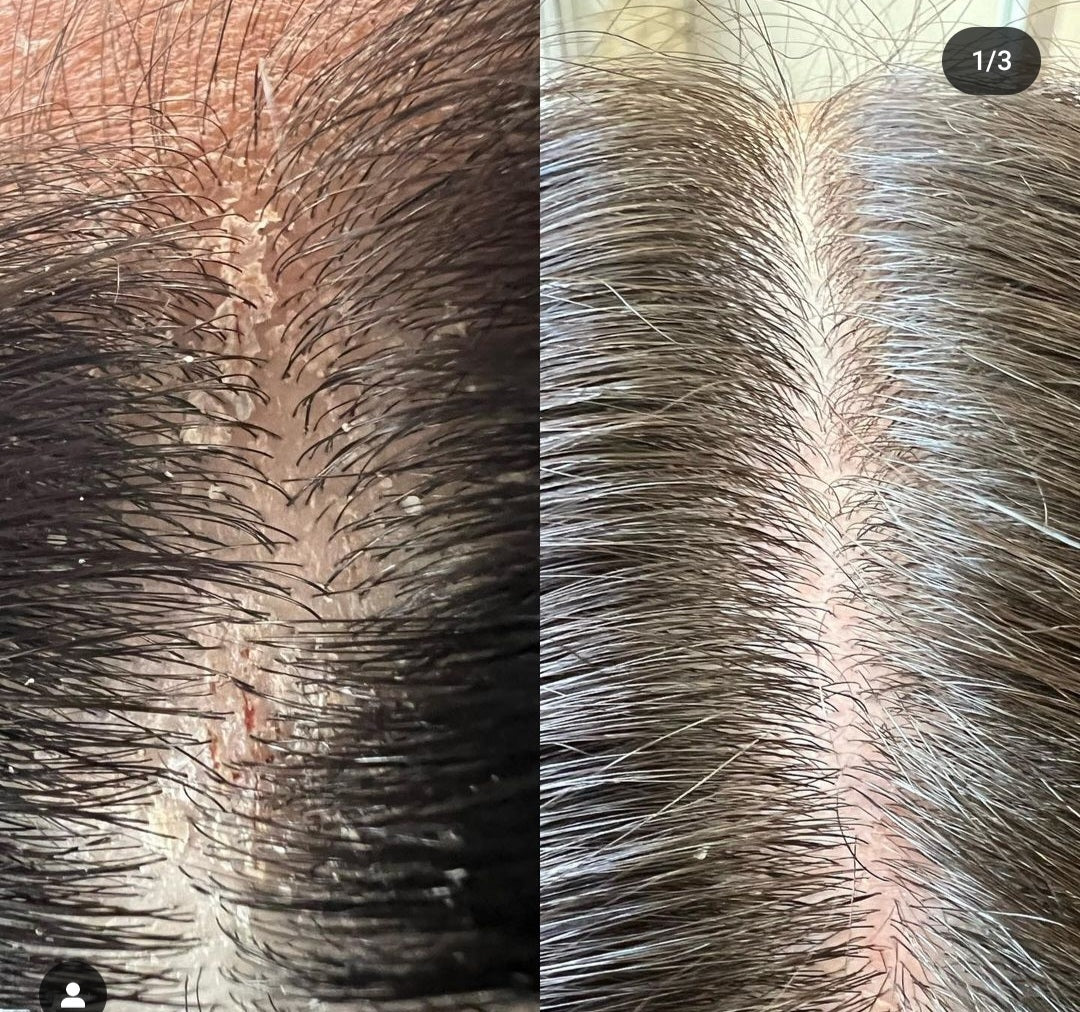 Anti-Schuppen-Shampoo Pflege für trockene, fettige Schuppen und schuppige Haut.