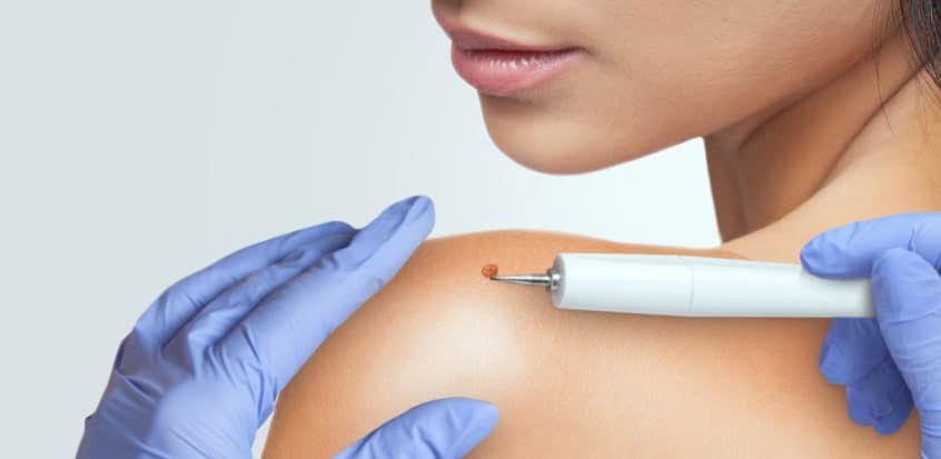 Warzen mit Fibroblast-Technologie