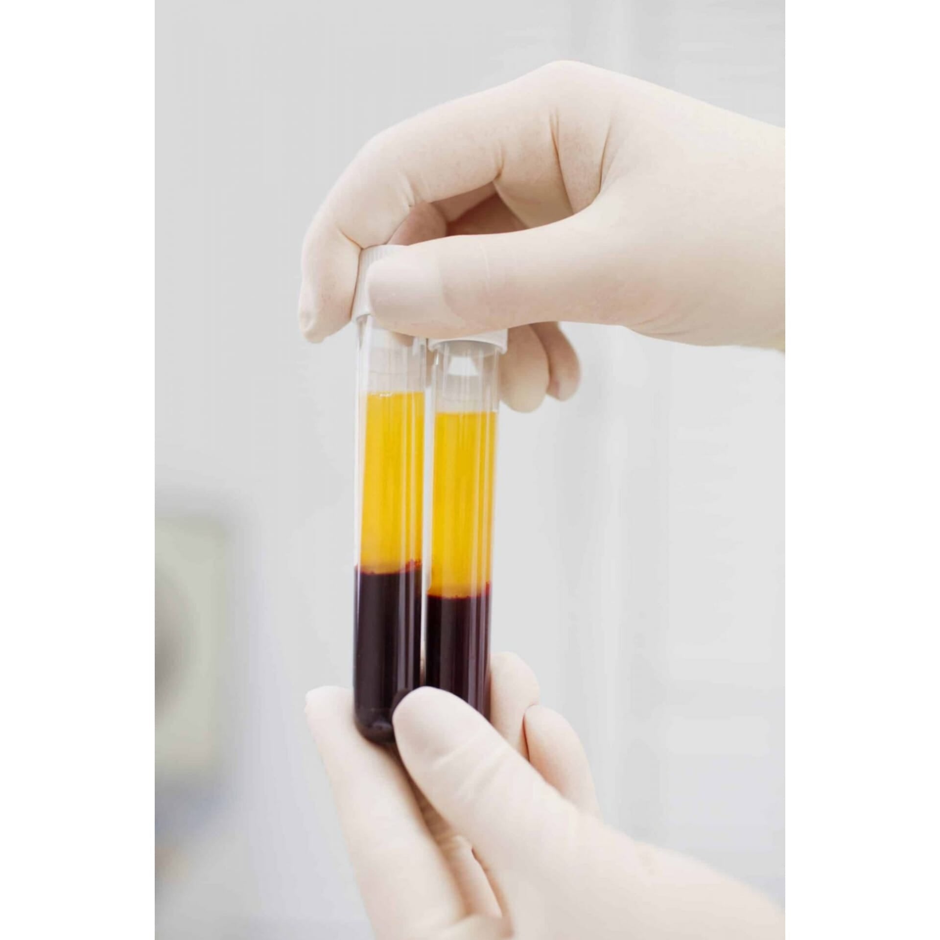 1 PRP facial treatment + 1 PRP hair treatment