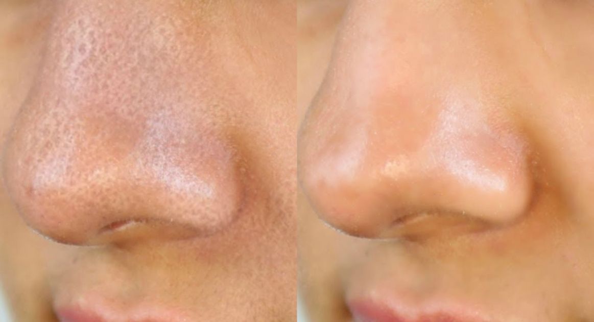 Face cleansing device HidraPlus GAIA
