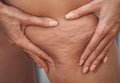 Cellulite mit Polymilchsäure (PLA