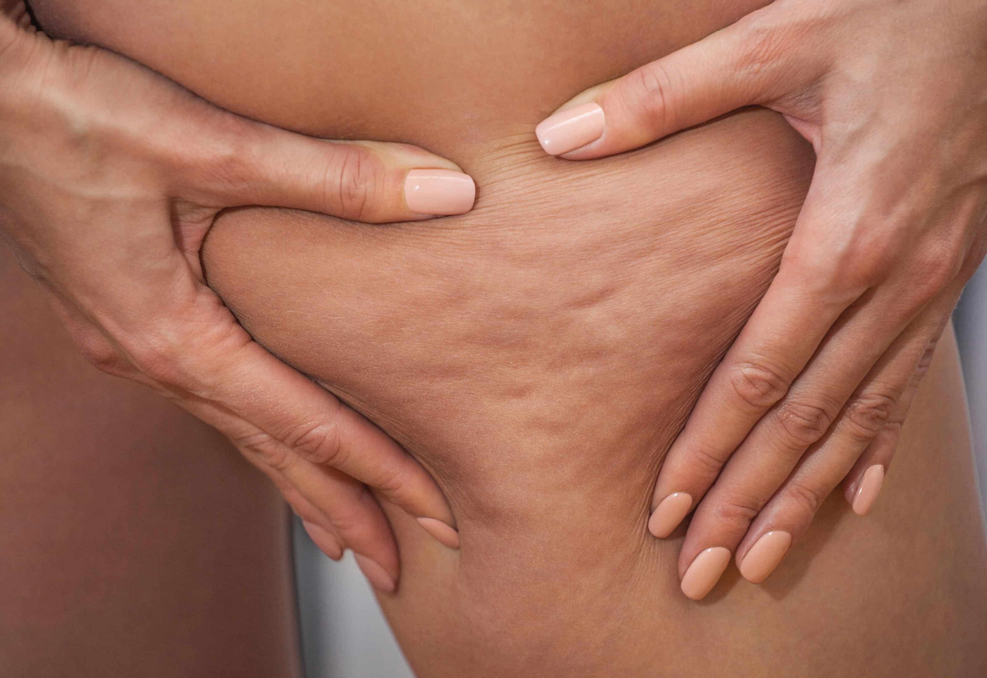 Cellulite mit Polymilchsäure (PLA