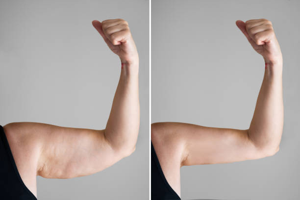 Fettentfernung mit PB Serum Enzymen
