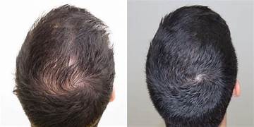 Capilcap Forte + Anti-Haarausfall-Shampoo 30 ml Nahrungsergänzungsmittel auf Basis von Sabal-Extrakt, Aminosäuren, Vitaminen und Mineralstoffen – KAPSELN