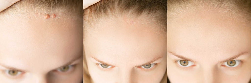 Warzen mit Fibroblast-Technologie